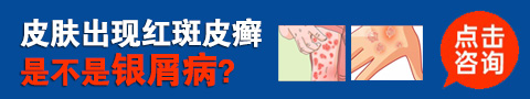 教你正确应对银屑病